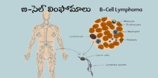 బి-సెల్ లింఫోమాలు: కారకాలు, లక్షణాలు, చికిత్స - B-Cell Lymphoma: Causes, Symptoms and Treatment B-Cell Lymphoma_ Causes, Symptoms and Treatment