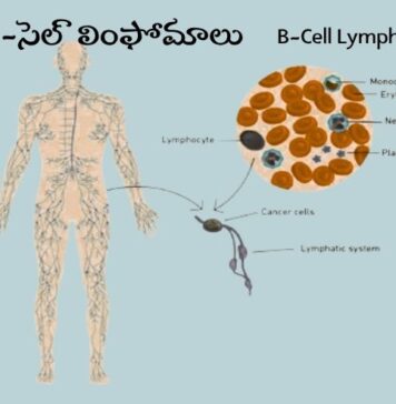 బి-సెల్ లింఫోమాలు: కారకాలు, లక్షణాలు, చికిత్స B-Cell Lymphoma_ Causes, Symptoms and Treatment