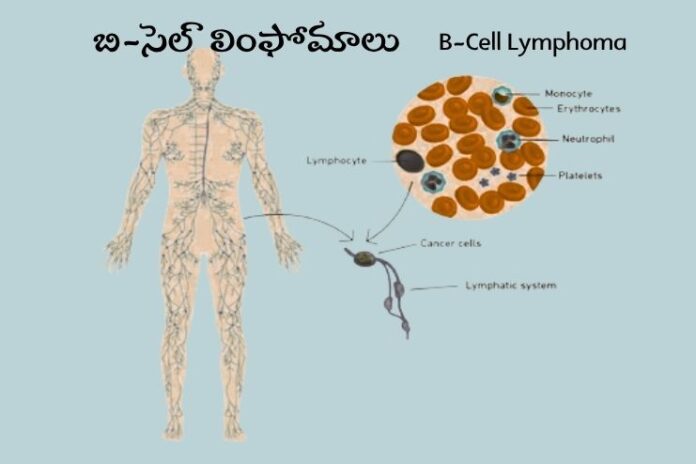 B-Cell Lymphoma_ Causes, Symptoms and Treatment B-Cell Lymphoma_ Causes, Symptoms and Treatment