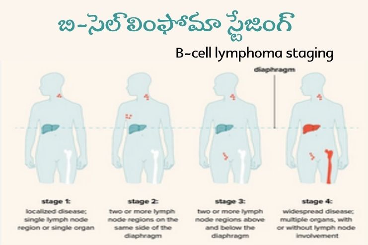 B-cell lymphoma staging