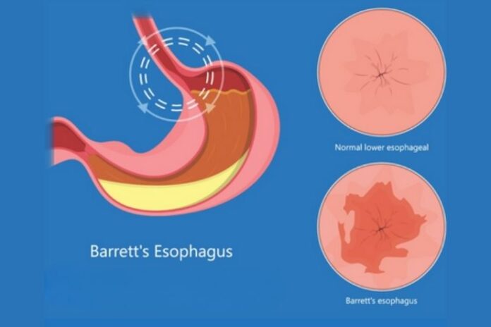 Barrett's esophagus-symptoms Barrett's esophagus-symptoms
