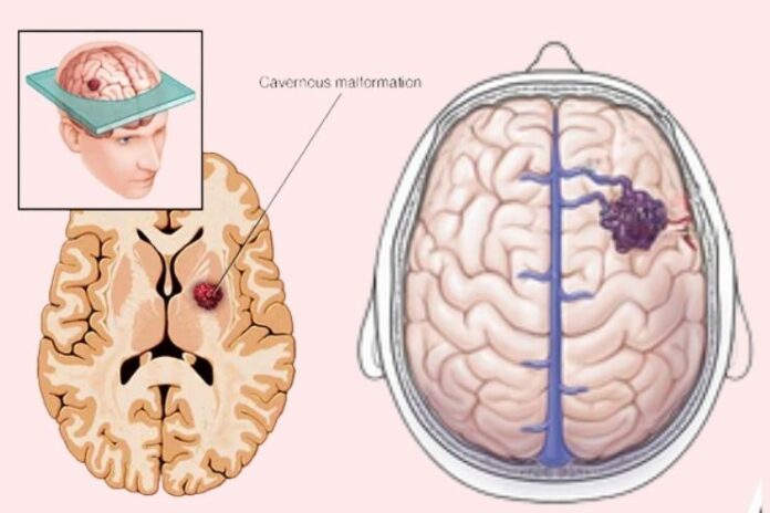Cerebral Cavernous malformations_ Causes, Symptoms and Treatment