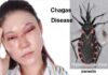 చాగస్ వ్యాధి: కారకాలు, లక్షణాలు, చికిత్స Chagas disease_ Symptoms, Causes, and How to Manage