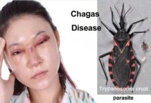 చాగస్ వ్యాధి: కారకాలు, లక్షణాలు, చికిత్స Chagas disease_ Symptoms, Causes, and How to Manage