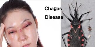 చాగస్ వ్యాధి: కారకాలు, లక్షణాలు, చికిత్స - Chagas disease: Causes, Symptoms and Treatment Chagas disease_ Symptoms, Causes, and How to Manage