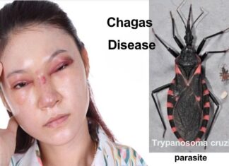 చాగస్ వ్యాధి: కారకాలు, లక్షణాలు, చికిత్స Chagas disease_ Symptoms, Causes, and How to Manage
