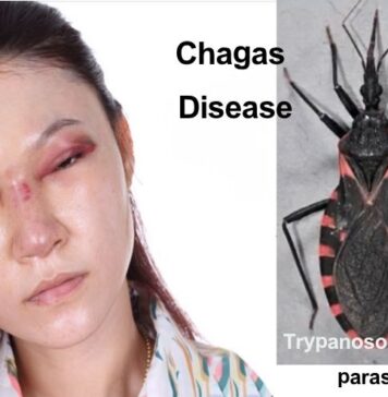చాగస్ వ్యాధి: కారకాలు, లక్షణాలు, చికిత్స Chagas disease_ Symptoms, Causes, and How to Manage