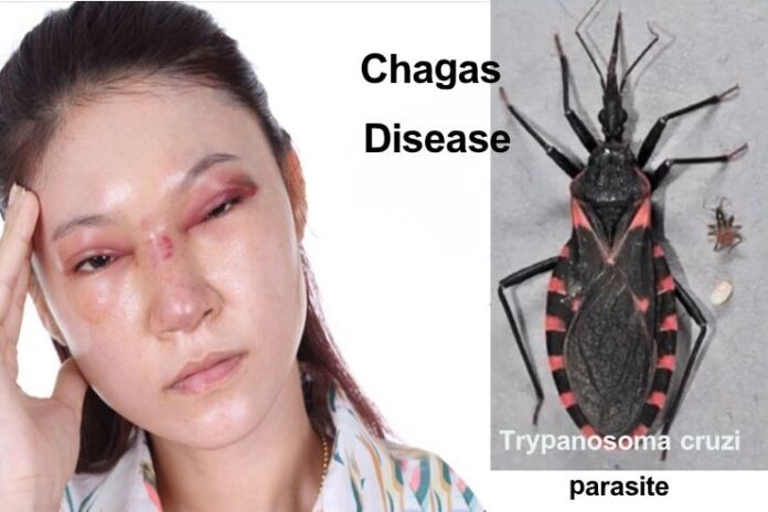 Chagas disease_ Symptoms, Causes, and How to Manage Chagas disease_ Symptoms, Causes, and How to Manage