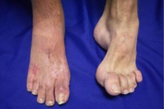 Charcot-Marie-Tooth Disease_Symptoms, and Causes Charcot-Marie-Tooth Disease_Symptoms, and Causes