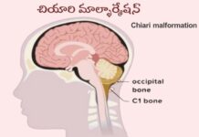 చియారి మాల్ఫార్మేషన్: కారణాలు, లక్షణాలు, చికిత్స Chiari _ Causes, Symptoms and Treatment