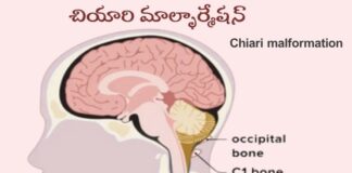 చియారి మాల్ఫార్మేషన్: కారణాలు, లక్షణాలు, చికిత్స - Chiari malformation: Causes, Symptoms and Treatment Chiari _ Causes, Symptoms and Treatment