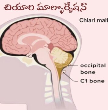 చియారి మాల్ఫార్మేషన్: కారణాలు, లక్షణాలు, చికిత్స Chiari _ Causes, Symptoms and Treatment