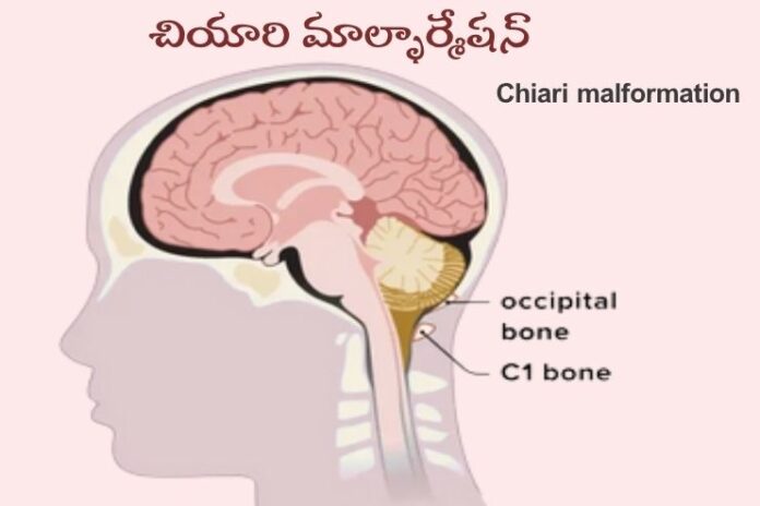 Chiari _ Causes, Symptoms and Treatment Chiari _ Causes, Symptoms and Treatment