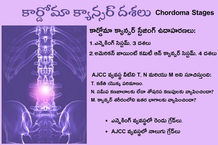 Chordoma Stages