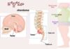 కార్డోమా: కారణాలు, లక్షణాలు మరియు చికిత్స Chordoma_ causes, Symptoms and Treatment