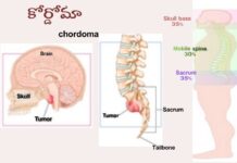 కార్డోమా: కారణాలు, లక్షణాలు మరియు చికిత్స Chordoma_ causes, Symptoms and Treatment