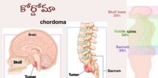 కార్డోమా: కారణాలు, లక్షణాలు మరియు చికిత్స - Chordoma: causes, Symptoms and Treatment Chordoma_ causes, Symptoms and Treatment