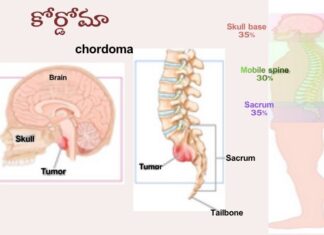 కార్డోమా: కారణాలు, లక్షణాలు మరియు చికిత్స Chordoma_ causes, Symptoms and Treatment