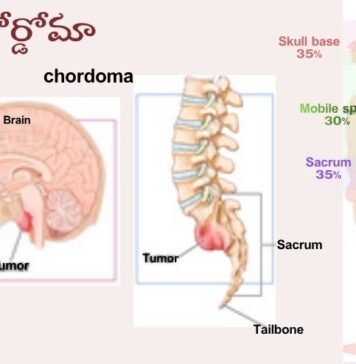 కార్డోమా: కారణాలు, లక్షణాలు మరియు చికిత్స Chordoma_ causes, Symptoms and Treatment