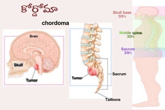 Chordoma_ causes, Symptoms and Treatment