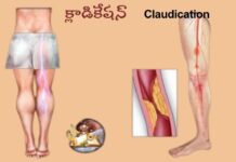 క్లాడికేషన్: కారణాలు, లక్షణాలు మరియు చికిత్స Claudication_ causes, Symptoms and Treatment