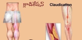 క్లాడికేషన్: కారణాలు, లక్షణాలు మరియు చికిత్స - Claudication: causes, Symptoms and Treatment Claudication_ causes, Symptoms and Treatment
