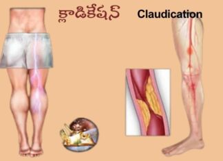 క్లాడికేషన్: కారణాలు, లక్షణాలు మరియు చికిత్స Claudication_ causes, Symptoms and Treatment