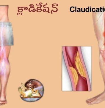 క్లాడికేషన్: కారణాలు, లక్షణాలు మరియు చికిత్స Claudication_ causes, Symptoms and Treatment
