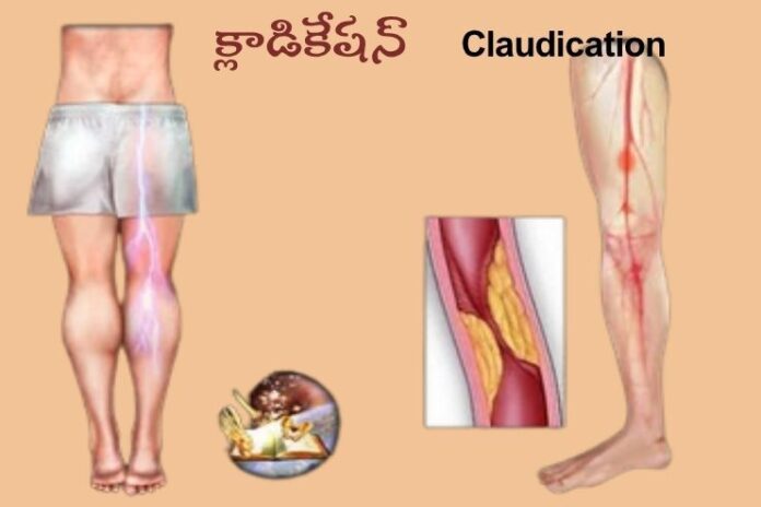 Claudication_ causes, Symptoms and Treatment