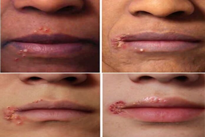 Cold sores_ Causes, and Treatments Cold sores_ Causes, and Treatments