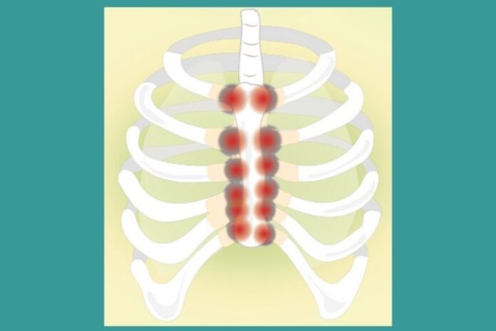 Costochondritis_ Causes, Symptoms and Treatment