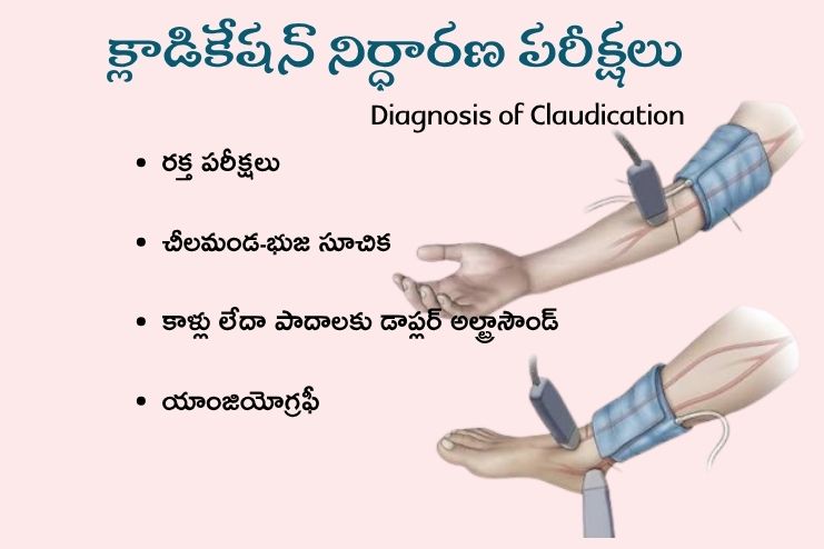 Diagnosis of Claudication