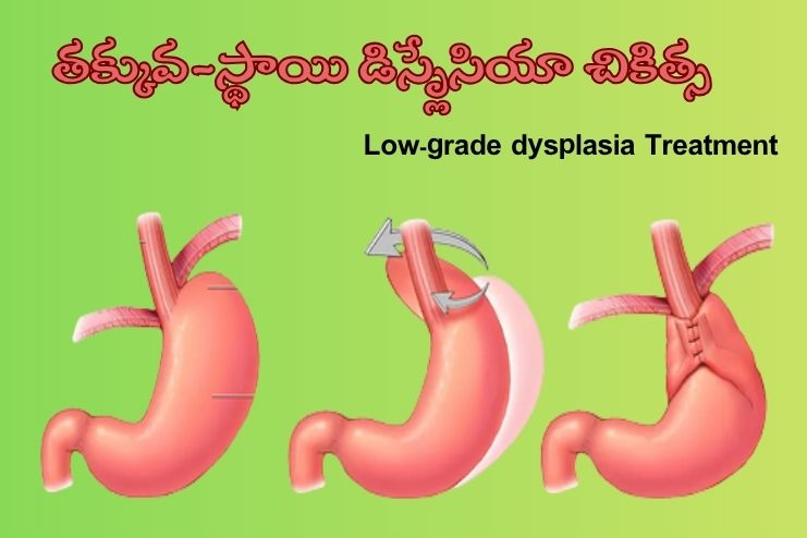 Low-grade dysplasia Treatment