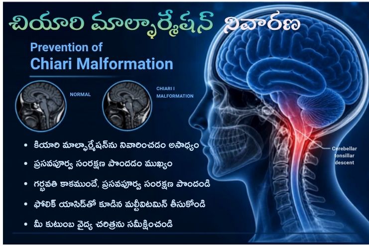 Prevention of Chiari