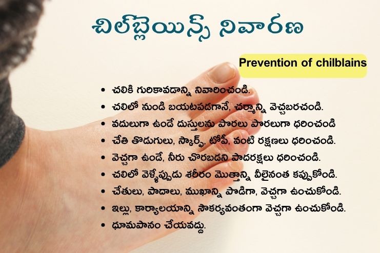 Prevention of chilblains