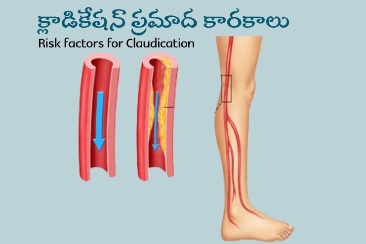 Medicines for Claudication
