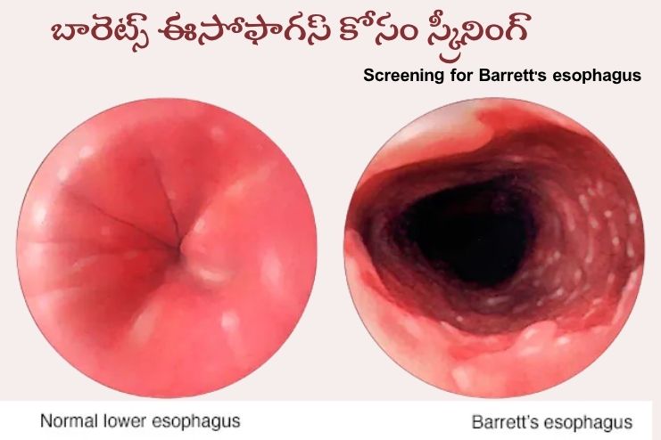 Screening for Barrett's esophagus