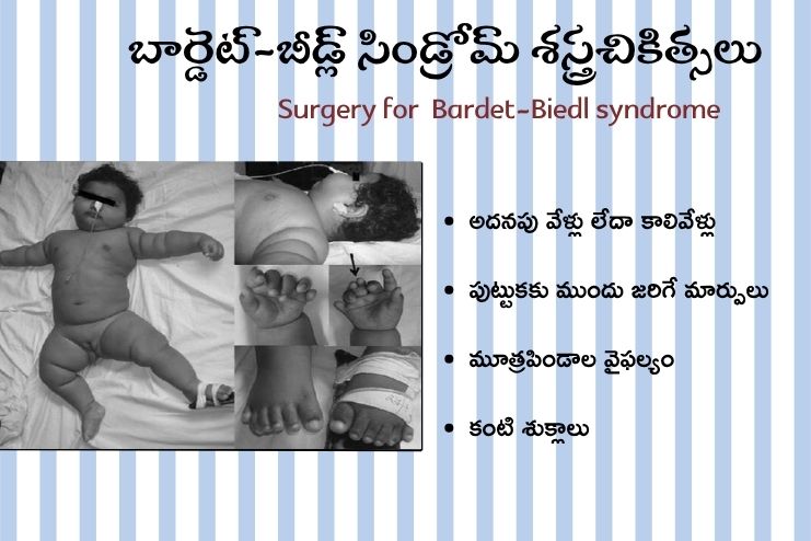 Surgery for Bardet-Biedl syndrome
