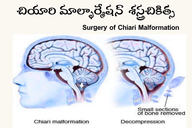 Surgery of chiari