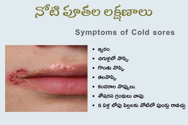 Symptoms of Cold sores