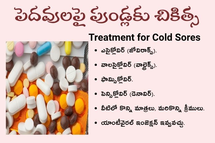 Treatment for Cold Sores