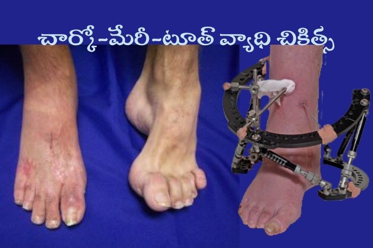 Treatment of CMT