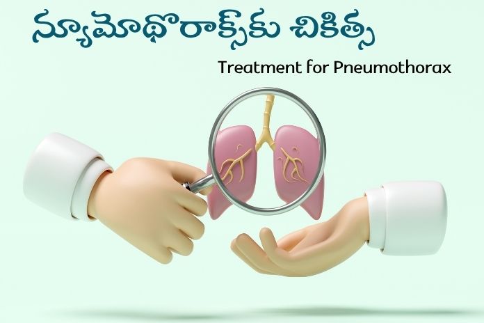 Treatment of Pneumothorax 2