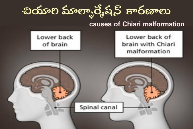chiari causes
