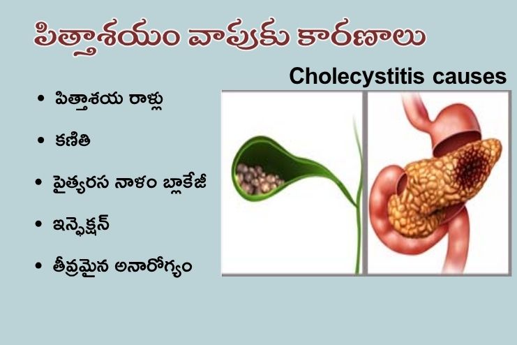 cholecystitis causes