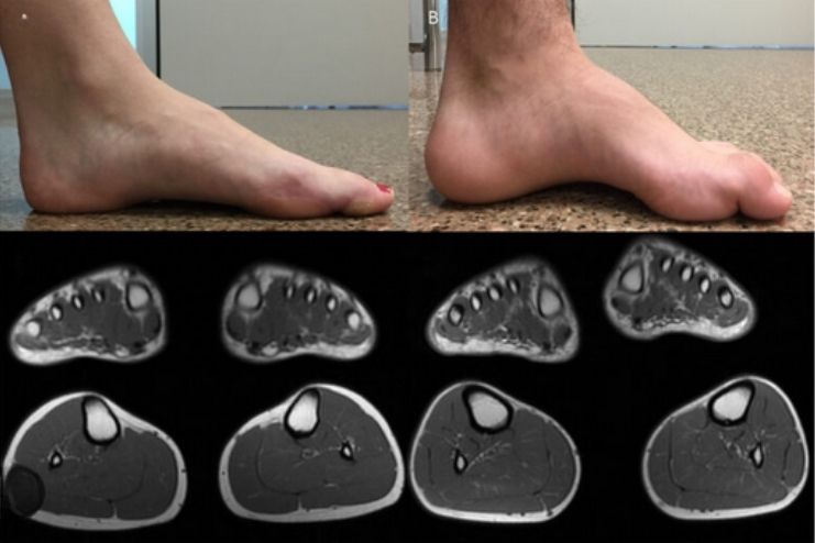 complications of CMT