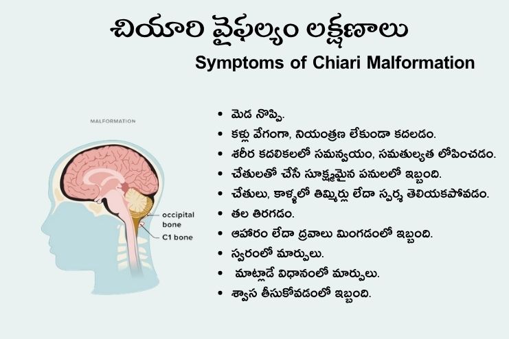 symptoms chiari