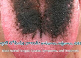 నల్లటి రోమపు నాలుక: కారణాలు & తొలగింపు వ్యూహాలు Black Haired Tongue_ Causes, Symptoms, and Treatment