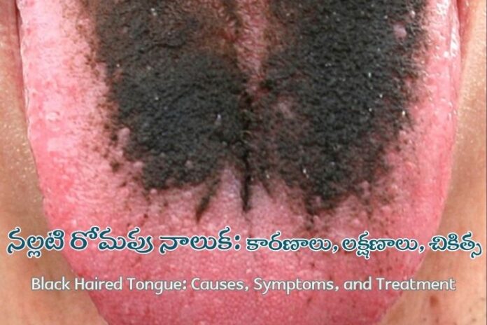 Black Haired Tongue_ Causes, Symptoms, and Treatment Black Haired Tongue_ Causes, Symptoms, and Treatment