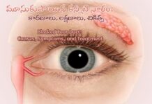 మూసుకుపోయిన కన్నీటి నాళం: కారణాలు, లక్షణాలు, చికిత్స Blocked Tear Duct_ Causes, Symptoms, and Treatment